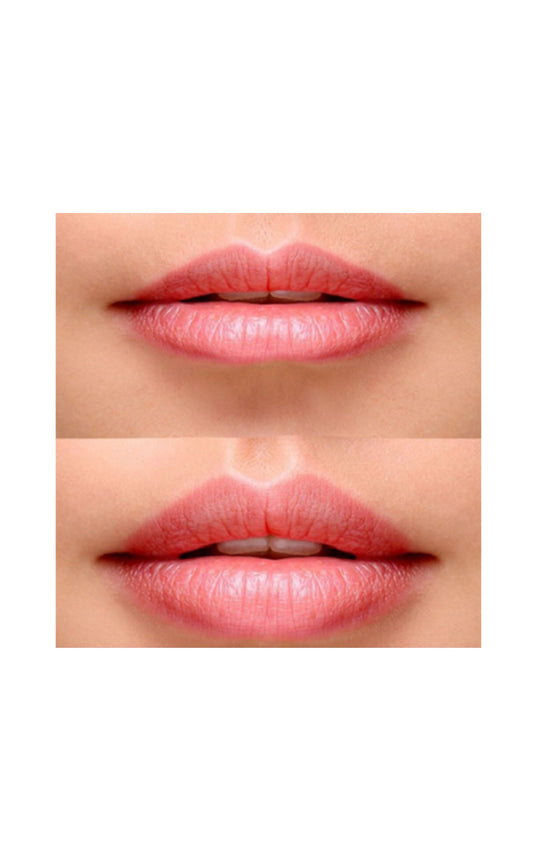 Aumento de labios con ácido hialurónico